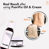 Psoriasis & Eczema Treatment Kit (Oil + Cream) | 100% Results with No Side Effect
