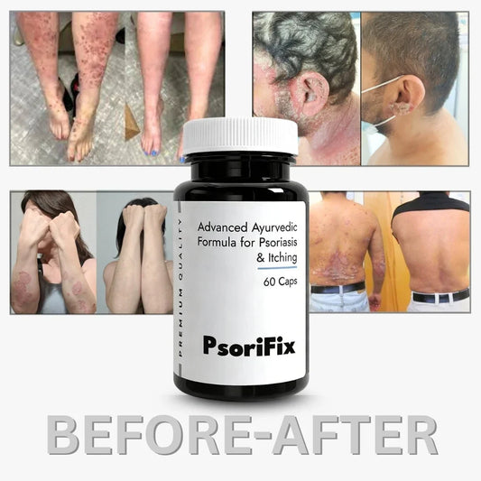 Psoriasis and the Immune System: How to Support Your Body Naturally Through Diet and Lifestyle