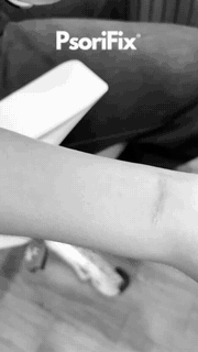 psorifix treatment result