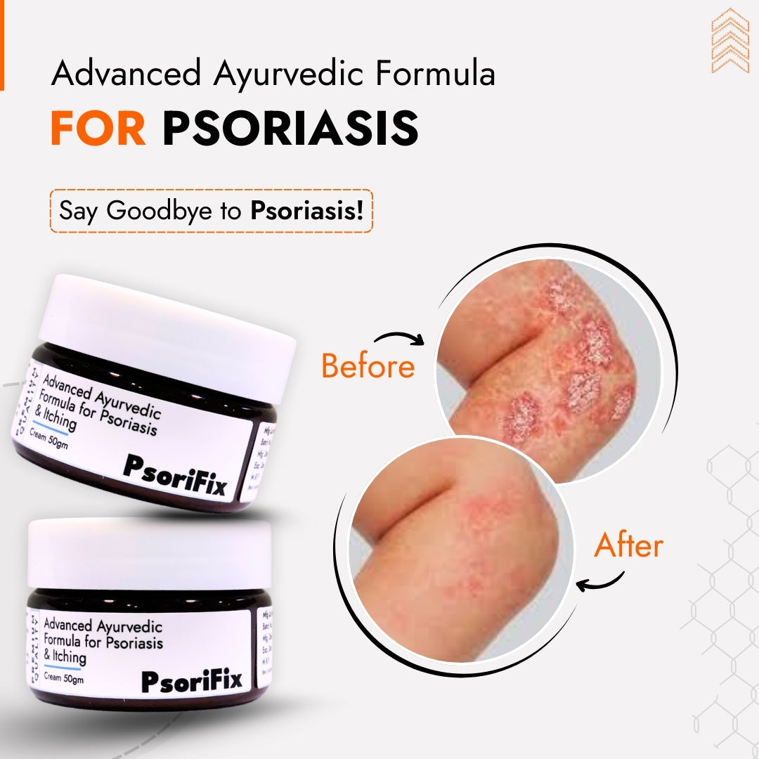 Psoriasis & Eczema Treatment Cream | Advanced Ayurvedic Formula with 100% Results