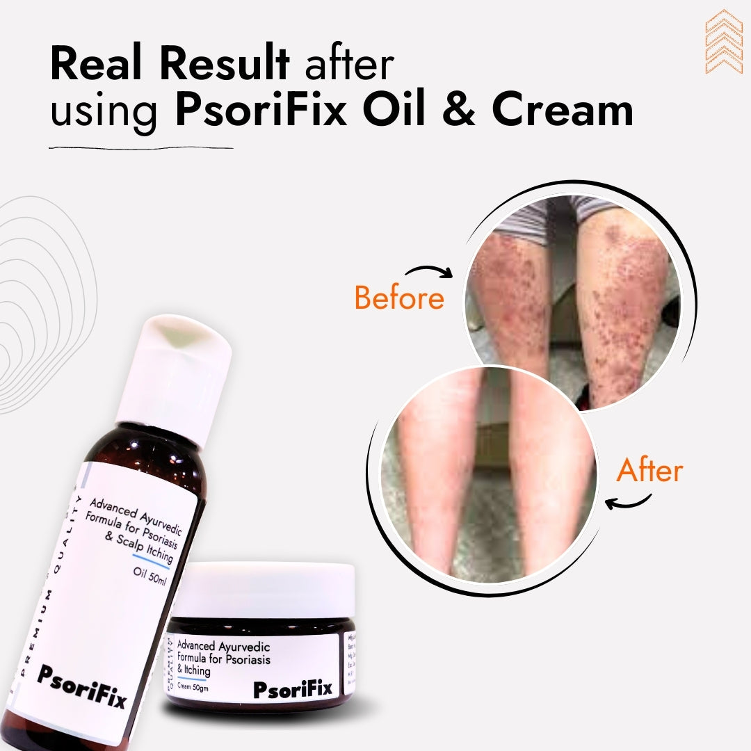 Psoriasis & Eczema Treatment Kit (Oil + Cream) | 100% Results with No Side Effect